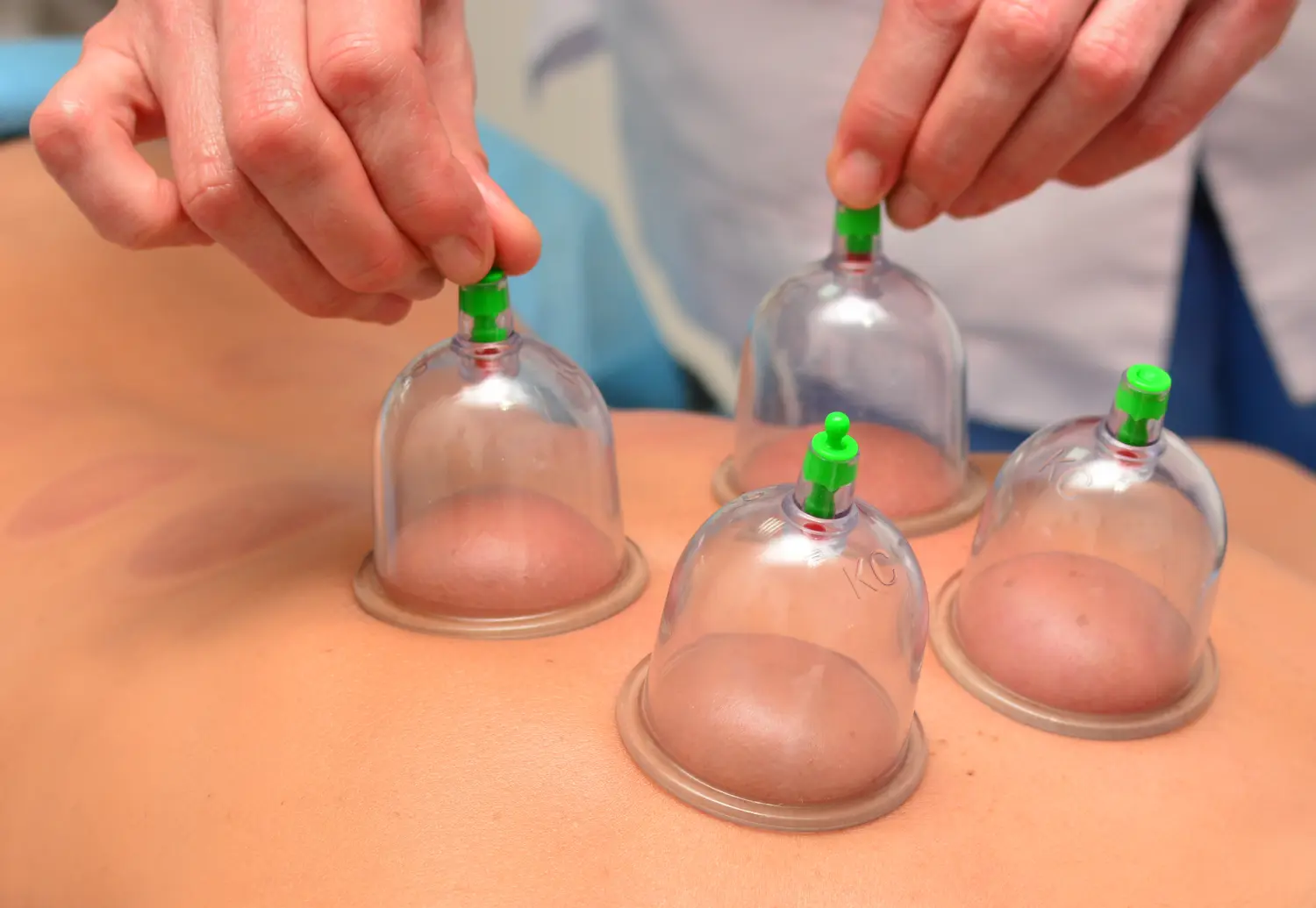 Schröpfen Medical Touch