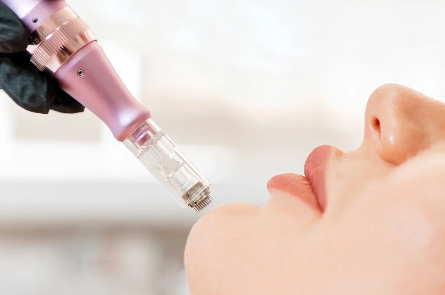 Microneedling Medical Touch